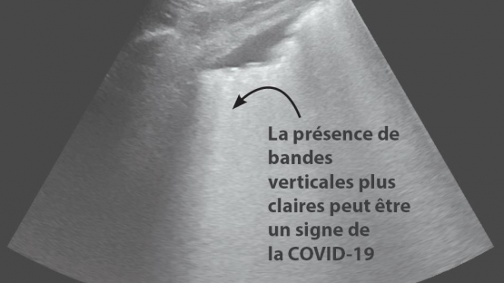 Ecographie covid-19