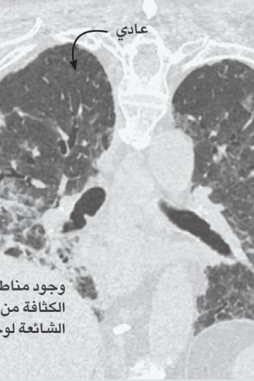 علاج التهاب الرئة كورونا