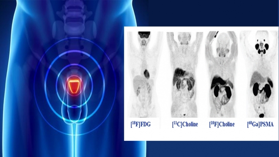 ga-68-psma pet/ct for prostate cancer ga-68-psma pet/ct for prostate cancer