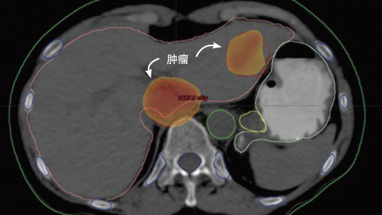 tumour-ch